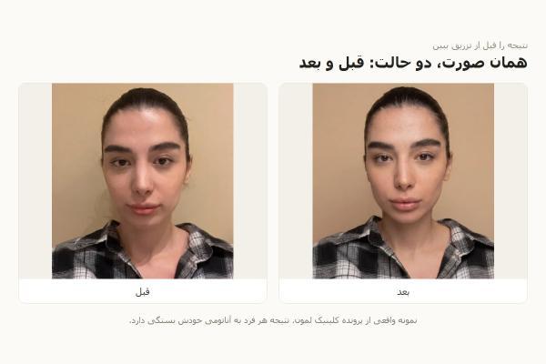 قبل از تزریق، نتیجه را ببینیم؟ کاری که هوش مصنوعی در مشاوره زیبایی می تواند بکند و کاری که نمی تواند